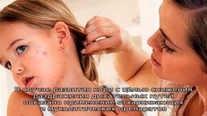 Что такое вирусный дерматит?