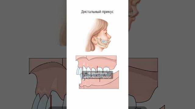 Как формируется дистальный и мезиальный прикус?