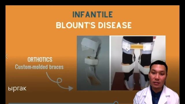 Ноги колесом. "Варусная деформация коленных суставов" смотреть онлайн