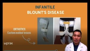 Ноги колесом. "Варусная деформация коленных суставов"