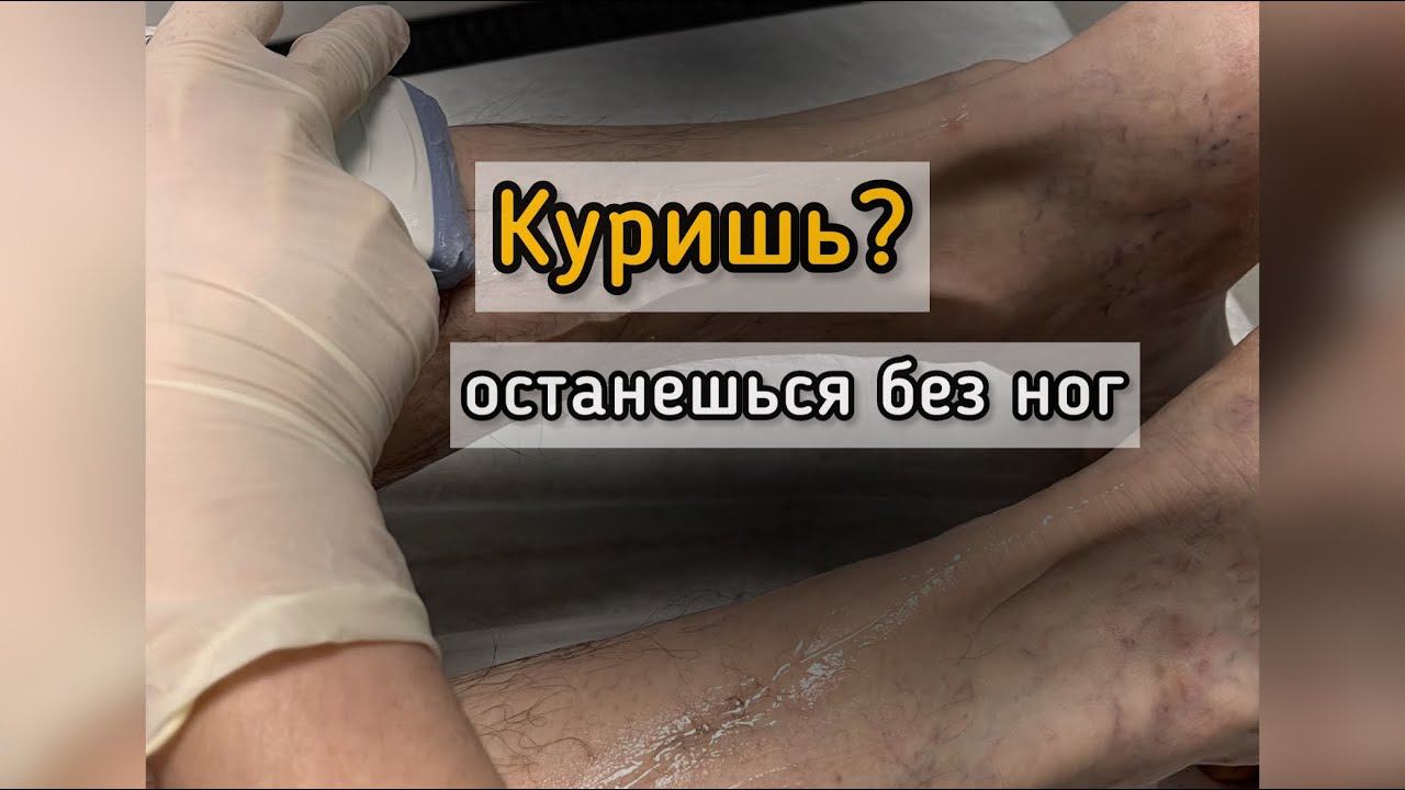 Полная окклюзия поверхностных бедренных артерий.
