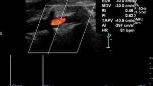 Диссекция позвоночной артерии