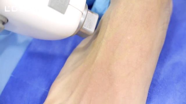 Proceso de depilación láser смотреть онлайн