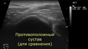 Патология головки плечевой кости