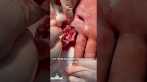 Застарелое повреждение сухожилий сгибателя и пальцевой ветки локтевого нерва