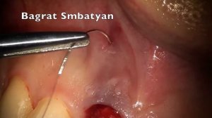 Одномоментная имплантация верхнего центрального резца