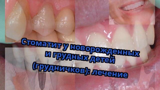 Стоматит у новорожденных и грудных детей (грудничков): лечение смотреть онлайн