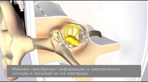 Как работает кохлеарный имплант