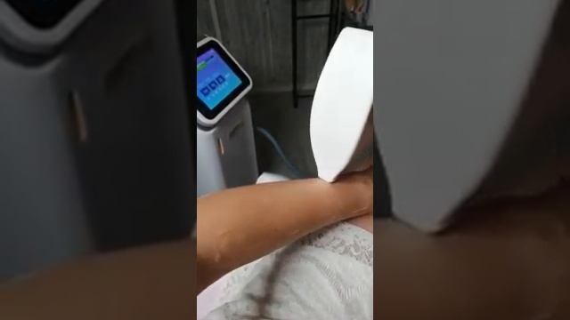 Лазерная эпиляция рук смотреть онлайн