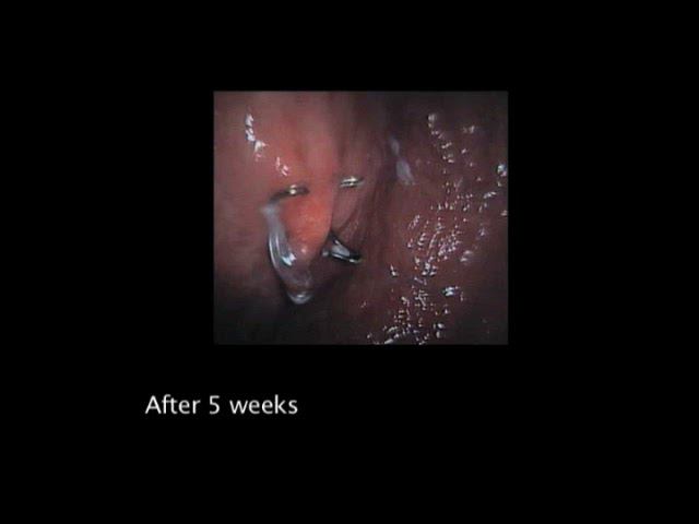 Healing process after OTSC application