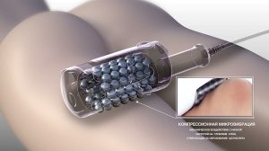 Endospheres Therapy (Эндосфера терапия) – инновационный метод похудения!