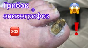 Грибок ? + Онихогрифоз ❗️⚠️?