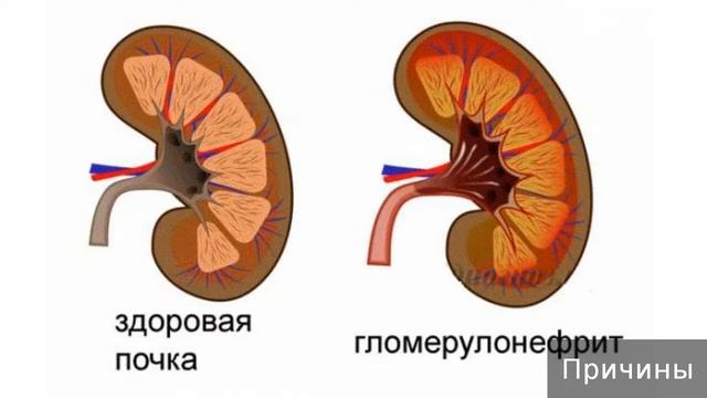 Гломерулонефрит. Как лечить гломерулонефрит. смотреть онлайн