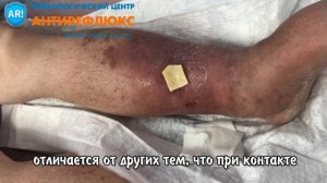 Как правильно выполнить туалет трофической язвы