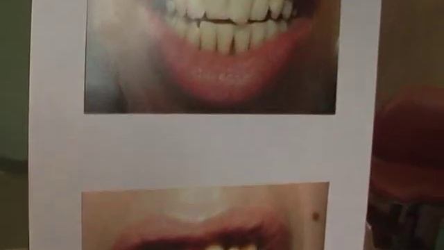 Зубные камни и профилактика пародонтита смотреть онлайн