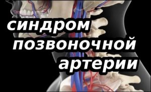 СИНДРОМ ПОЗВОНОЧНОЙ АРТЕРИИ ЭТО. ПРИЧИНА И ЛЕЧЕНИЕ.
