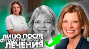 Меняется ли лицо после ортодонтического лечения?