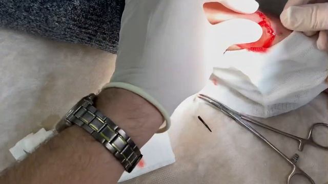 Удаление инородного тела правой кисти смотреть онлайн