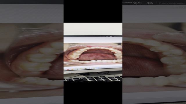 Разбор клинического случая пациента с лечением на элайнерах
