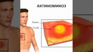 Онлайн урок "Актиномикоз челюстно - лицевой области "