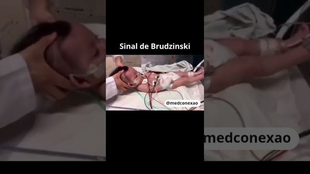 Sinal de Brudzinski