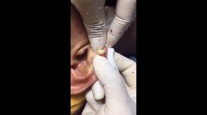 БОЛЬШОЙ ЧИРЕЙ/БОЛЬШОЙ ЧИРЯК/БОЛЬШОЙ ПРЫЩ/БОЛЬШОЙ ГНОЙНИК