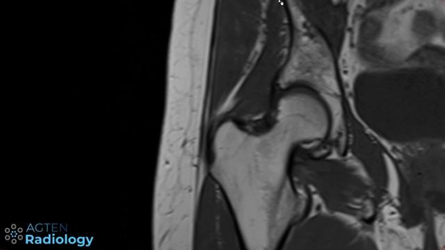 Hip abductor tendon MRI anatomy смотреть онлайн