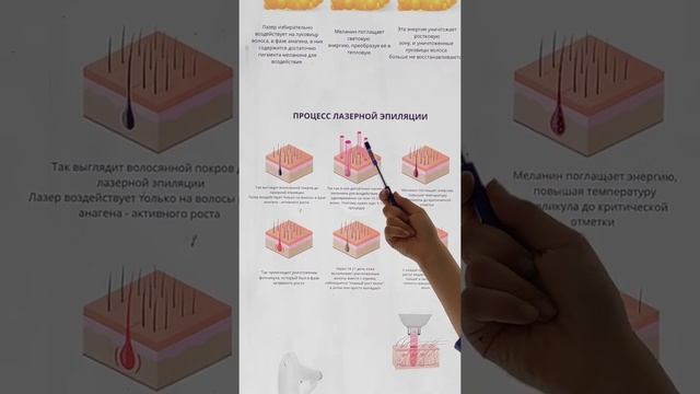 Принцип работы лазерной эпиляции смотреть онлайн