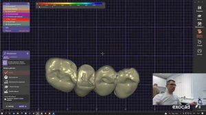 2 часть: CAD\CAM. 3D cканирование в Medit, Exocad модельер и печать временных конструкций.