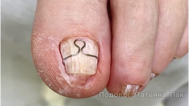 Отвращение от вида ногтей | сделать из ? конфетку | результат ?/?? смотреть онлайн