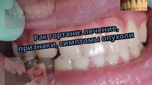 Рак гортани: лечение, признаки, симптомы опухоли