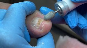 Онихомикоз | Онихокриптоз | лечение клиента