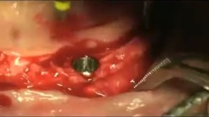 Установка имплантатов Dentium SuperLine при полном отсутствии зубов