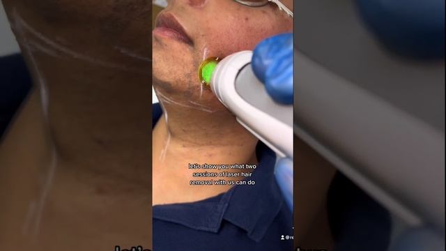 Laser hair removal on the face?