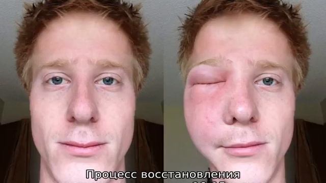 Что делать, если укусил шершень смотреть онлайн