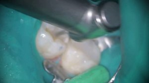 Лечение кариеса нижних моляров