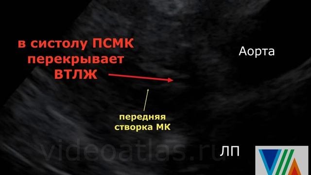 Подклапанный стеноз Ао. Другой вариант.