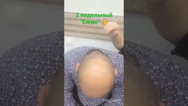 "Ёжик" после пересадки волос спустя 2 недели .Географт/Geograft. смотреть онлайн