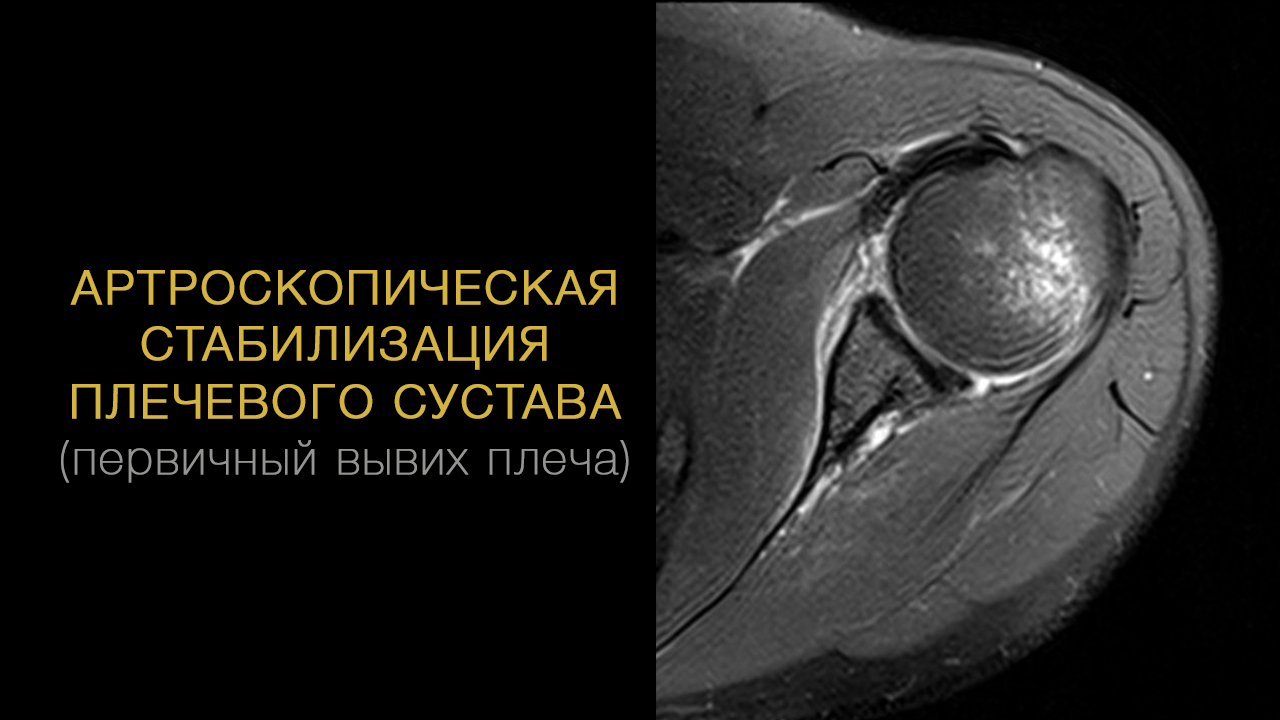 Артроскопическая стабилизация плечевого сустава (первичный вывих плеча)
