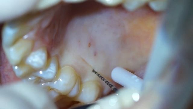 Двухслойная методика закрытия рецессий