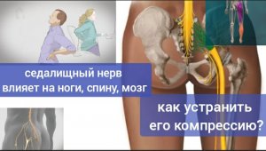 Сдавленный седалищный нерв мешает жить ногам, спине, мозгу. Упражнения для разблокировки