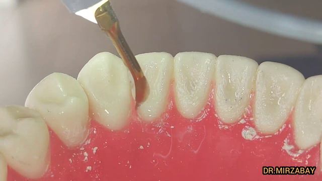 remove tartar professional teeth cleaning | профессиональная чистка зубов # 2 смотреть онлайн