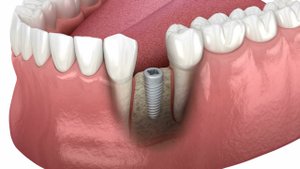 Установка формирователя десны, а после имплантата