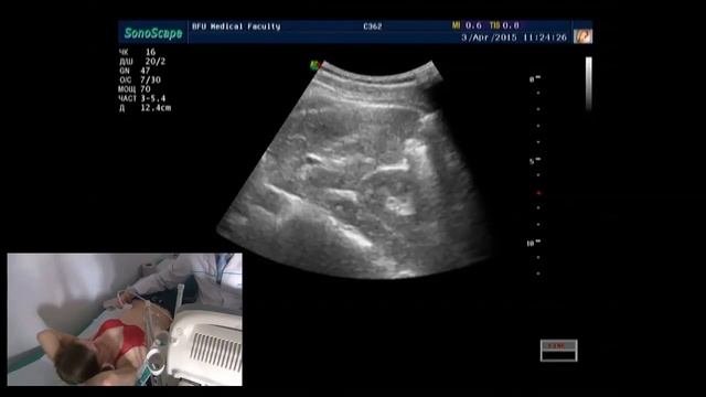 Ультразвуковая анатомия почек. Демонстрация на пациенте