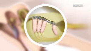 Wie funktioniert ein Cochlea-Implantat? | MED-EL