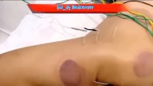 Иглотерапия