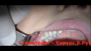 Удаление зуба мудрости  на верхней челюсти