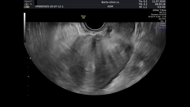 Эндометриоидный инфильтрат толстой кишки и два рубца на матке после кесарева сечения смотреть онлайн