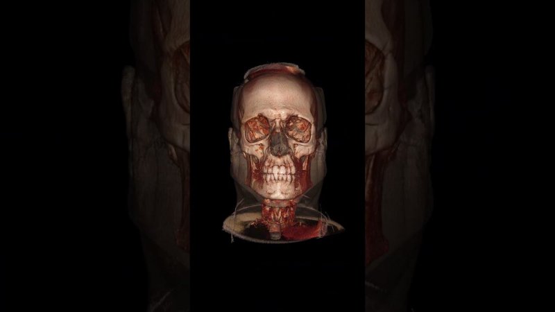 New features of Inobitec DICOM Viewer 2.12