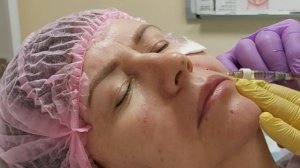 АирисКом студенты учатся: введение филлера. Малярные мешки, носогубная складка, морщина под губой.